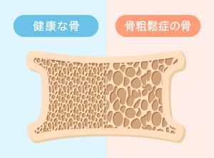健康な骨と骨粗鬆症の骨